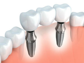 Implants | Dr. Park | Hopkinton & Hopedale, MA Dentist