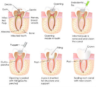 Endodontics | Dr. Park | Hopkinton & Hopedale, MA Dentist