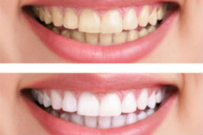 Teeth Whitening | Dr. Park | Hopkinton & Hopedale, MA Dentist