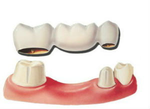 Dental Bridges | Dr. Park | Hopkinton & Hopedale, MA Dentist